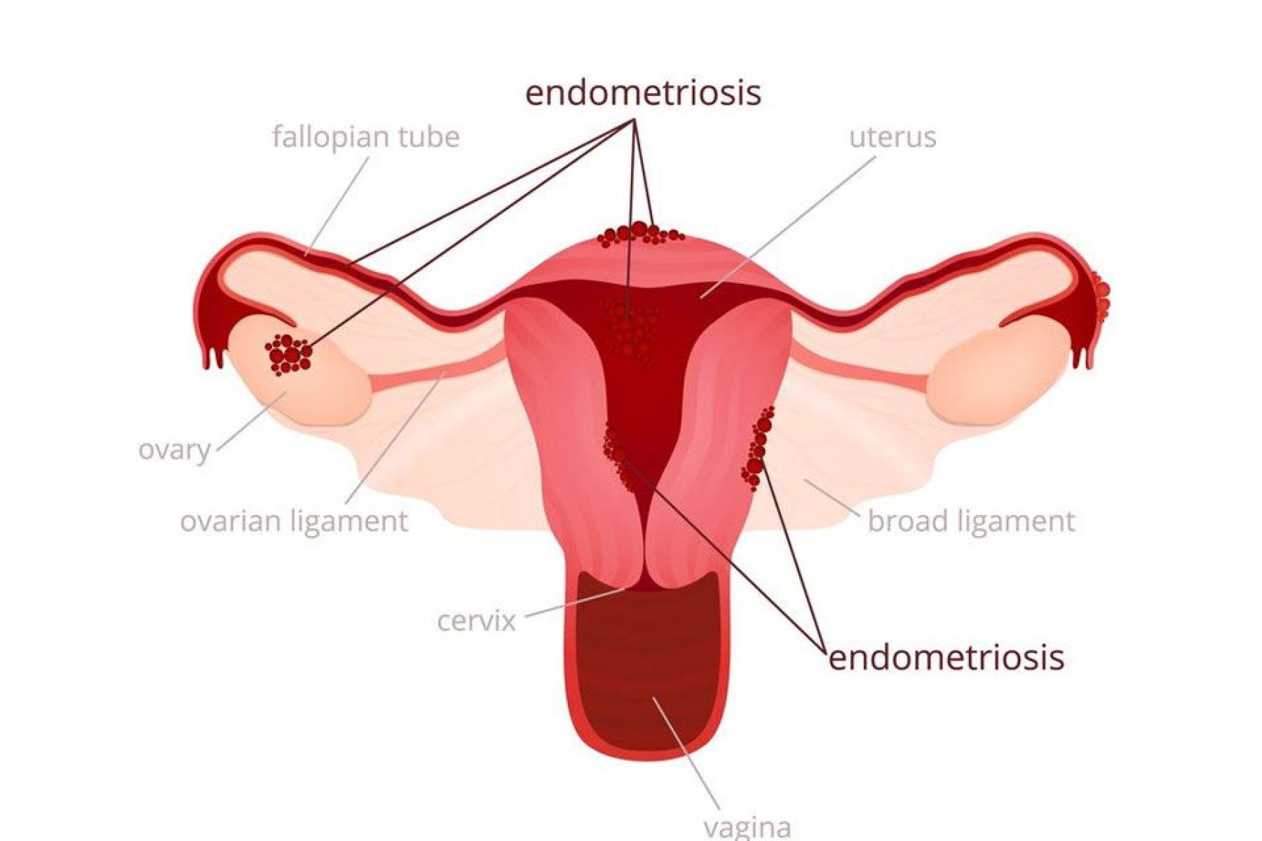 What is endometriosis?